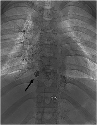 Case Report: Disseminated Systemic Embolism of Lipiodol After Lymphography for Plastic Bronchitis After Fontan Repair